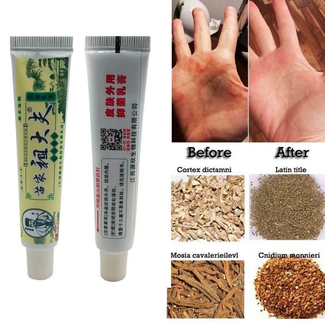 Psorijaza kineska biljna krema ZUDAIFU;antibakterijska krema za svrab i kožne bolesti poput alergije, dermatitisa, psorijaze, ekcema, antifungalni tretman